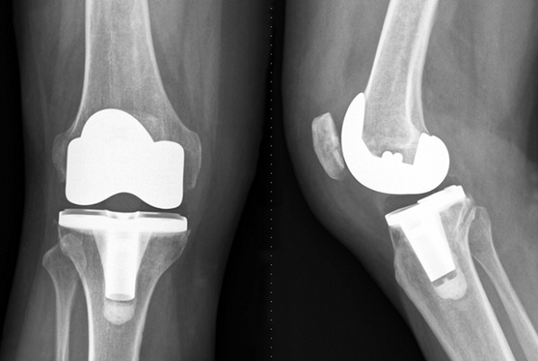 Knee Replacement