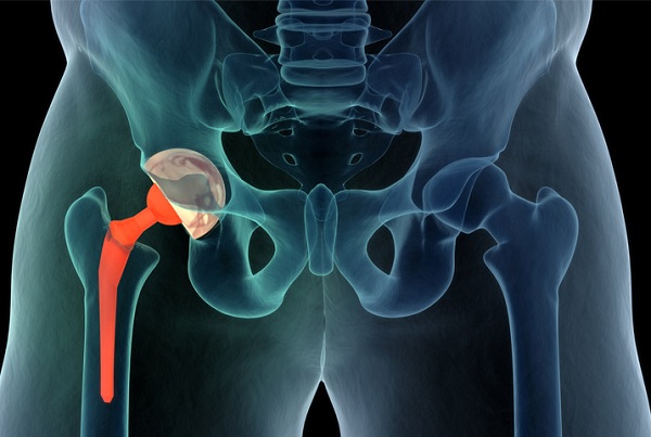 Hip Replacement