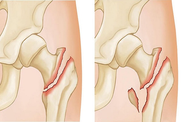 Hip Fracture