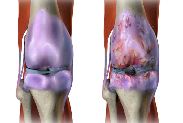 Osteoarthritis
